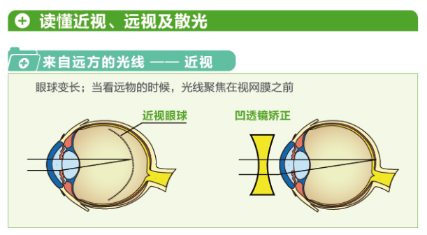 【圖文詳解】帶您“看透”近視遠(yuǎn)視及散光