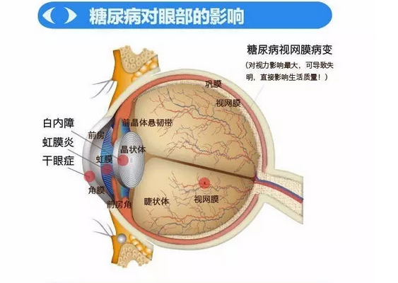 你造嗎？糖尿病晚期眼睛會致盲！