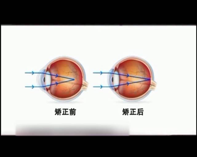 一夜之間真的能改變視力嗎？