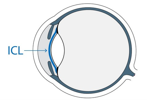 ICL晶體植入術(shù)，矯正的高度近視“神器”