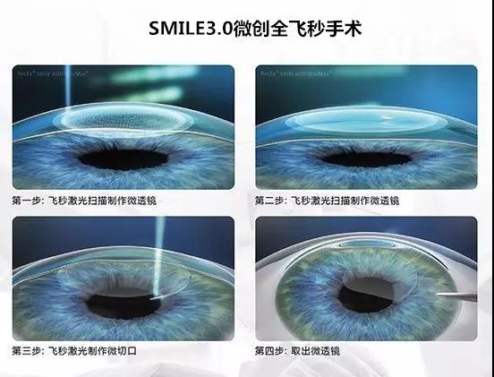 全國(guó)SMILE 之星手術(shù)視頻秀決賽 武漢普瑞眼科躋身前五