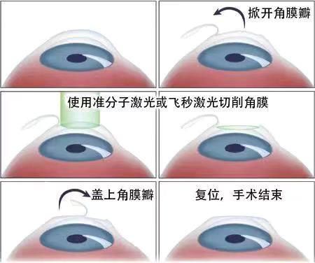 如果眼睛近視了該怎么？